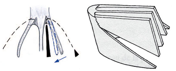 Fig. 7: In fractures for mini-rhinoplasty.