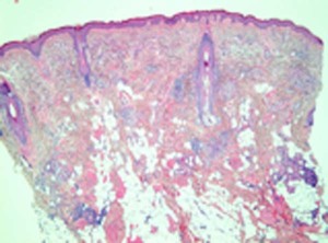 Histologie; links Übersicht (HE, x4), rechts Detail (HE, x20).